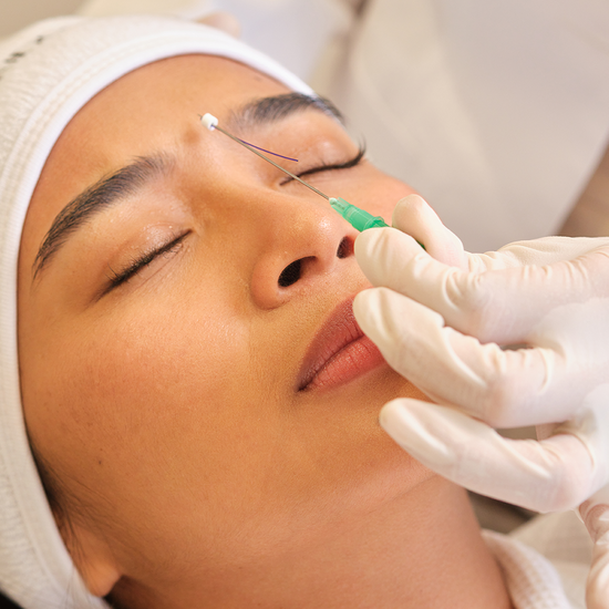 Threadlift procedure at Wunderskin