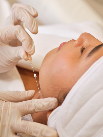 The process of a Facial Threadlift at Wunderskin